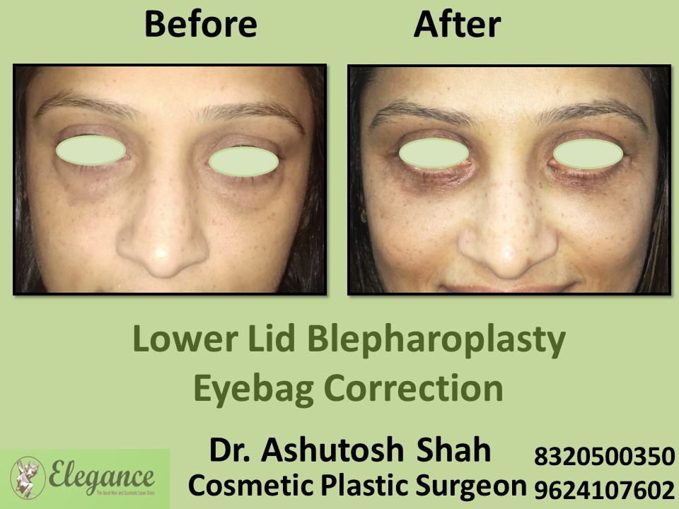 Lower Lid Blepharoplasty, Eye Correction in Piplod, Surat