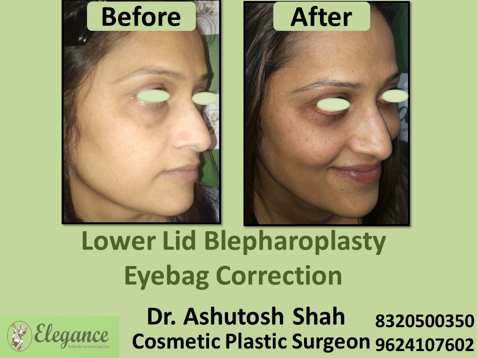 Lower Lid Blepharoplasty, Eye Correction in Udhna, Surat