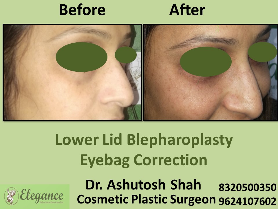 Lower Lid Blepharoplasty, Eye Correction in Pal, Surat