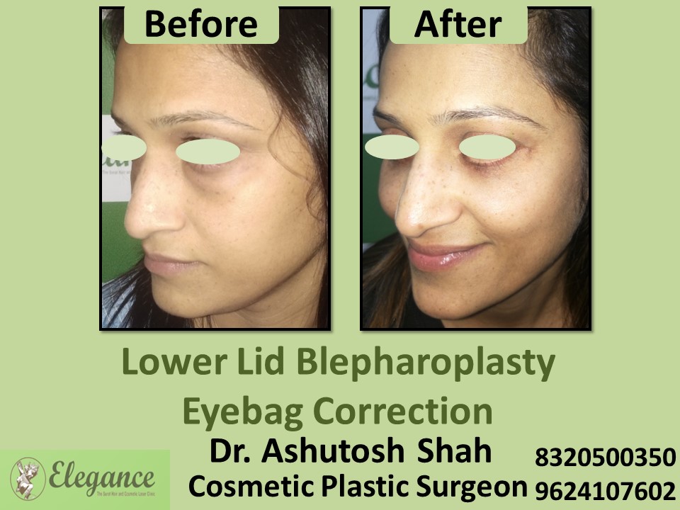 Lower Lid Blepharoplasty, Eye Correction in Adajan, Pal, Surat