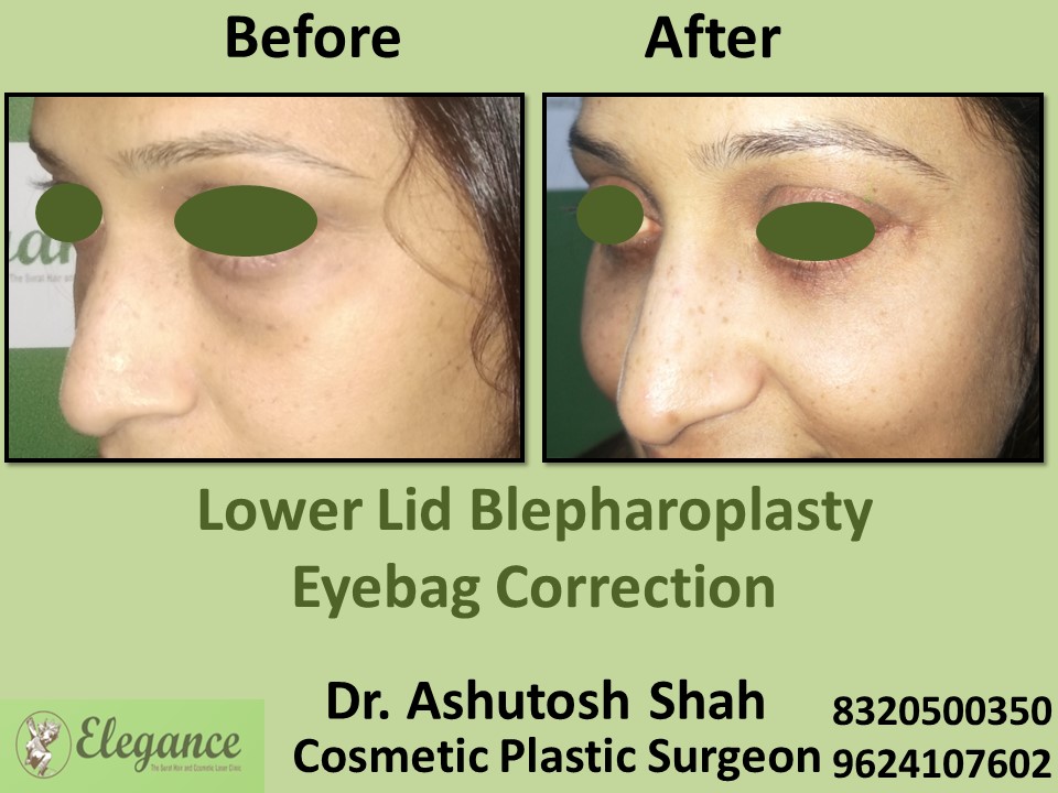 Lower Lid Blepharoplasty, Eye Correction in Adajan, Rander, Surat