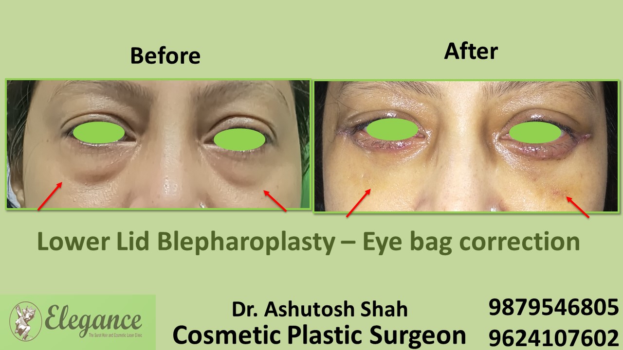 Eye Bag Correction
