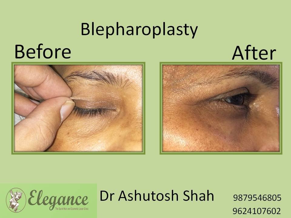 Blepharoplasty In Mumbai, Maharashtra, India