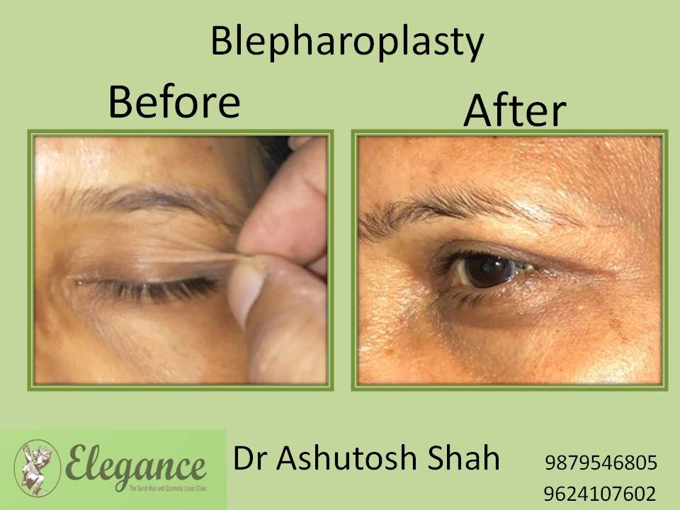 Blepharoplasty Surgery Price In Pune, Maharashtra, India