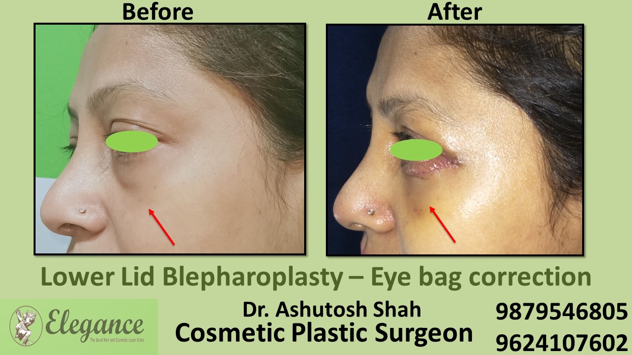 Eye Bag Correction in Vapi