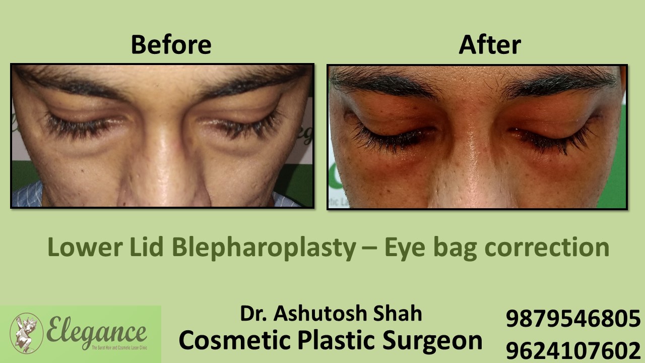 Eye Bag Correction in Valsad, Surat