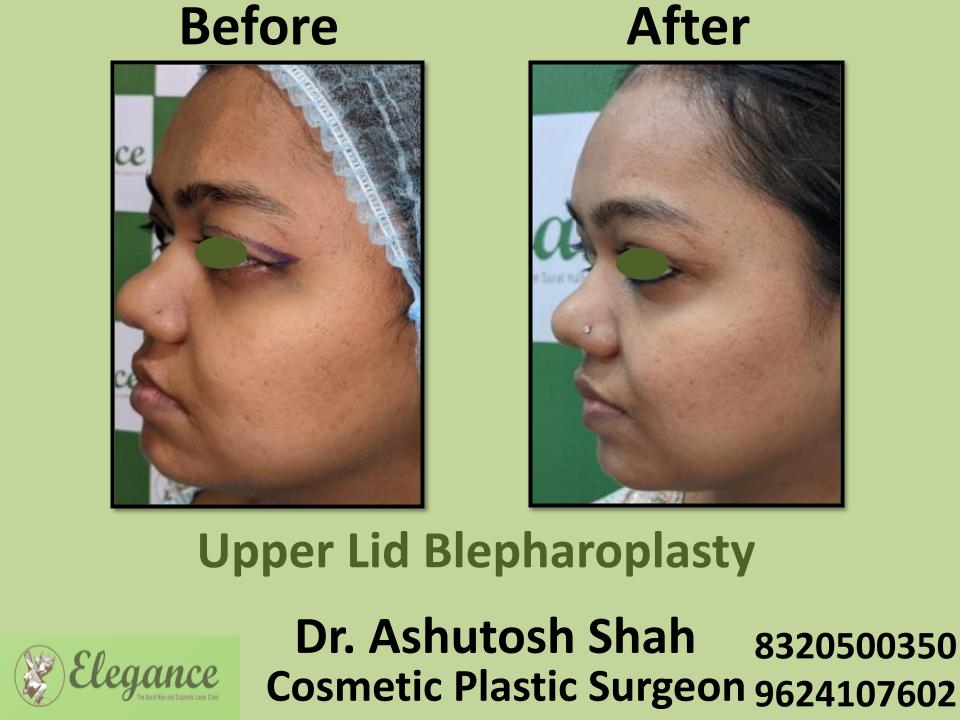 Upper Lid Bleapharoplasty, Upper Eyelid Correction Surgery, Ahemdabad, Mumbai, Rajkot, Nasik, India.