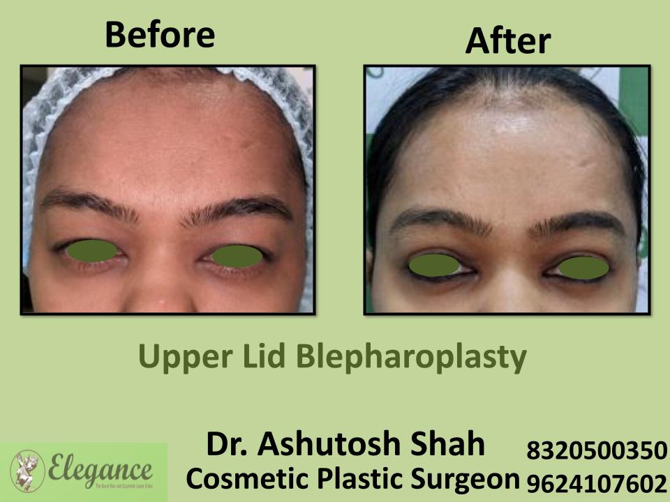 Upper Lid Bleapharoplasty, Upper Eyelid Excess Skin Removal Surgery, Sarthana, Tapi, Indore, Udaipur, Surat, Ahemdabad, India.