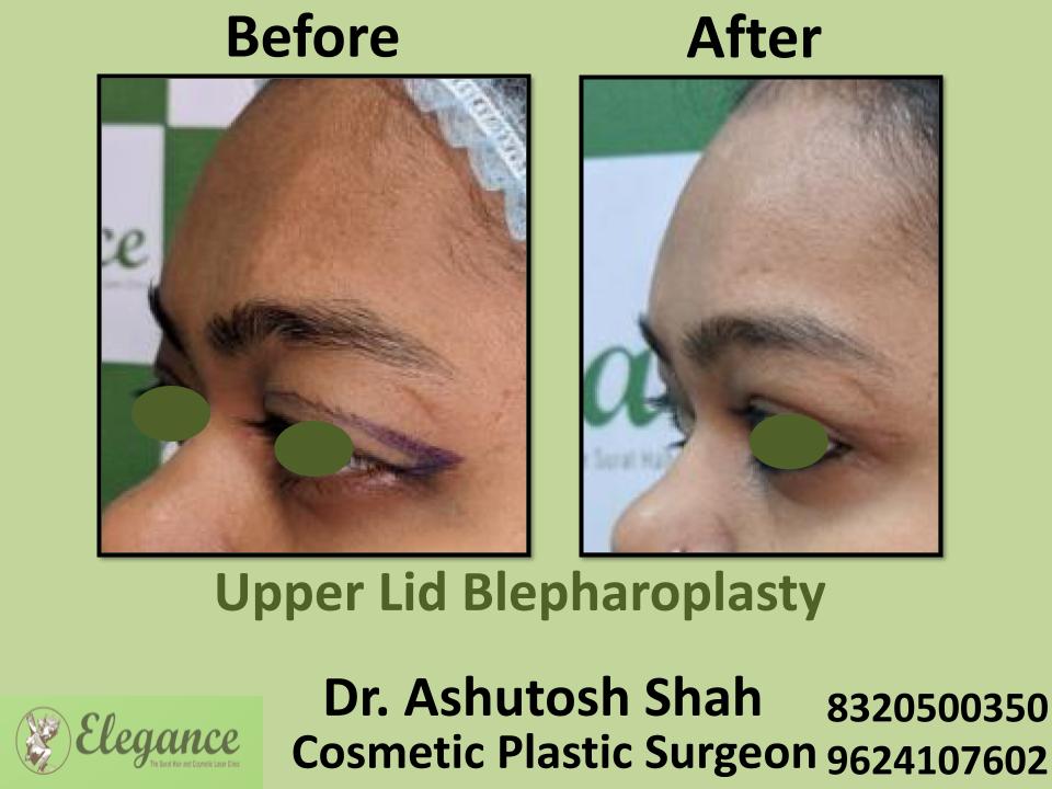 Upper Lid Bleapharoplasty, Upper Eyelid Fat Removal Surgery, Pandesara, Dindoli, Varaccha, Olpad, Surat, Gujarat.