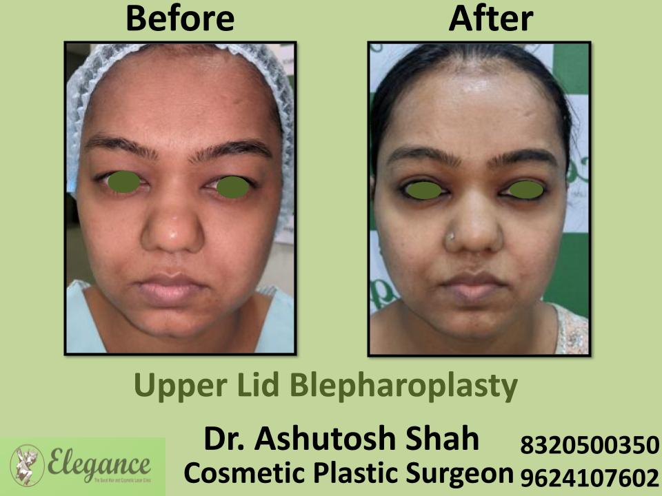 Upper Lid Bleapharoplasty, Upper Eyelid LIft Surgery, Tapi, Dang, Navsari, Ahemdabad, Vadodra, Gujarat.