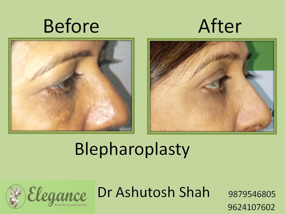 Blepharoplasty Surgery in Surat, Gujarat.