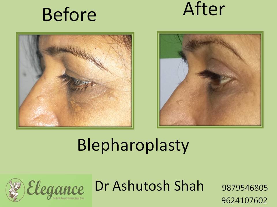 Blepharoplasty Surgery in Valsad, Gujarat.