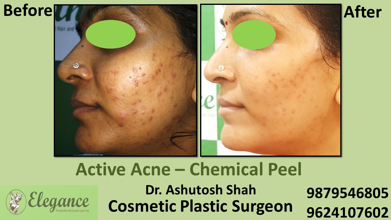 Acne Chemical Peel Treatment in Bilimora, Vapi Surat