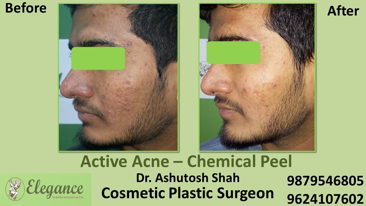 Acne Chemical Peel Treatment in Kosamba, Bardoli Surat