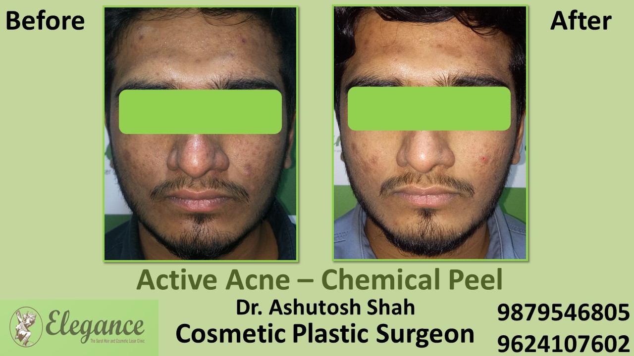 Acne Chemical Peel Treatment in Navsari, Kim, Surat
