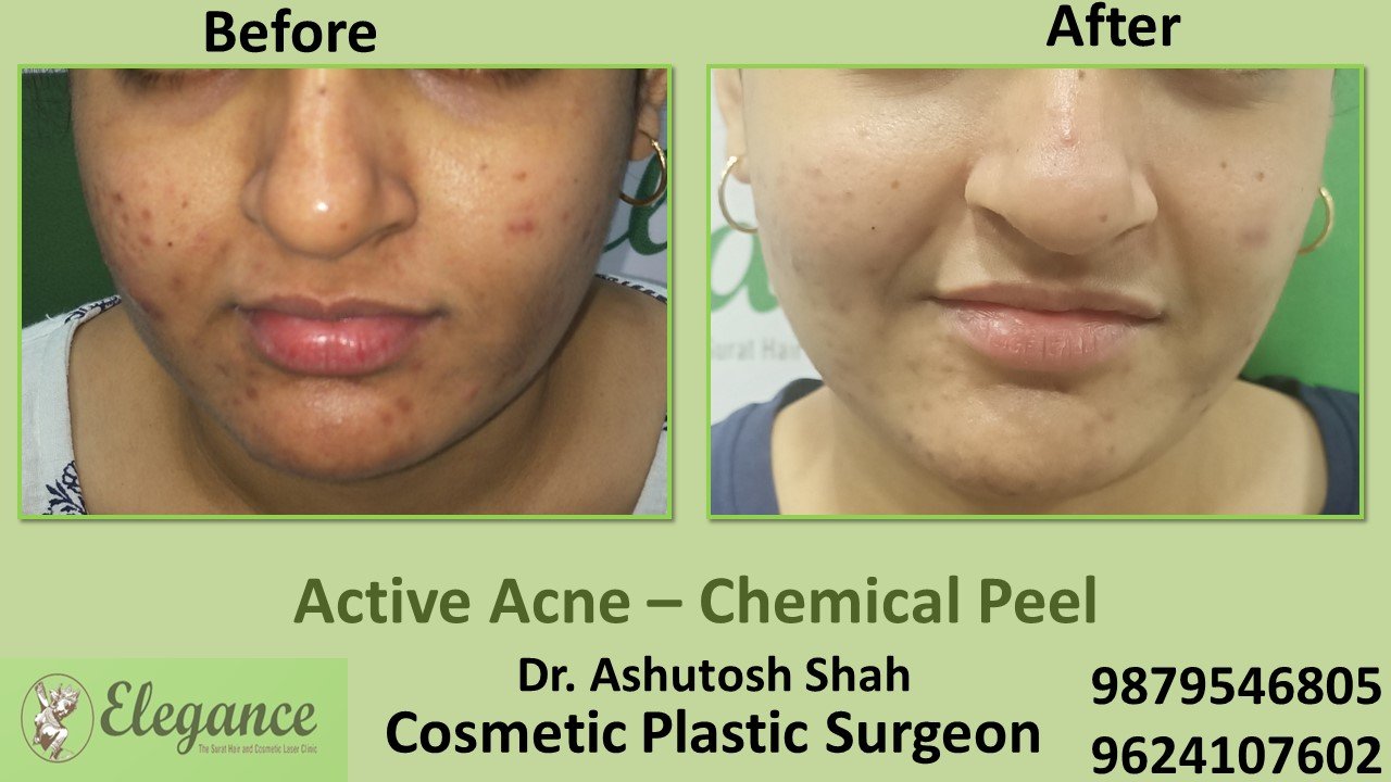 Acne Chemical Peel Treatment in Navsari, Vapi, Surat