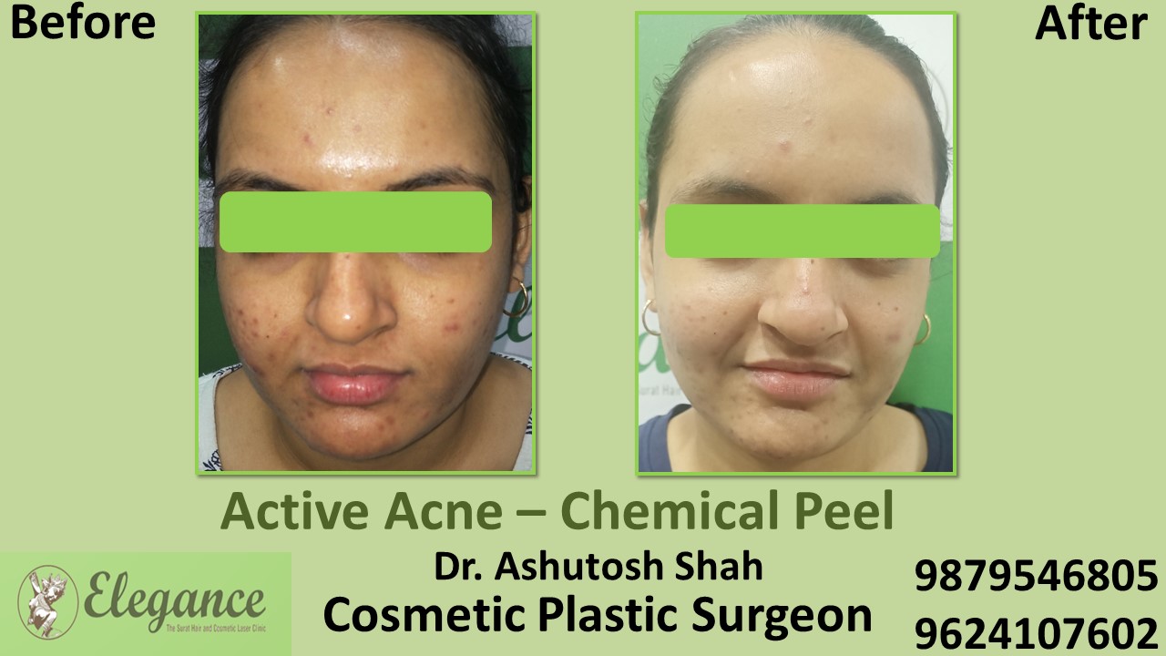 Acne Chemical Peel Treatment in Valsad, Vapi, Surat