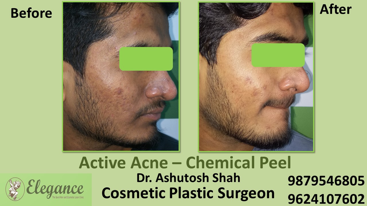 Acne Chemical Peel Treatment in Valsad,Kim, Vapi, Surat