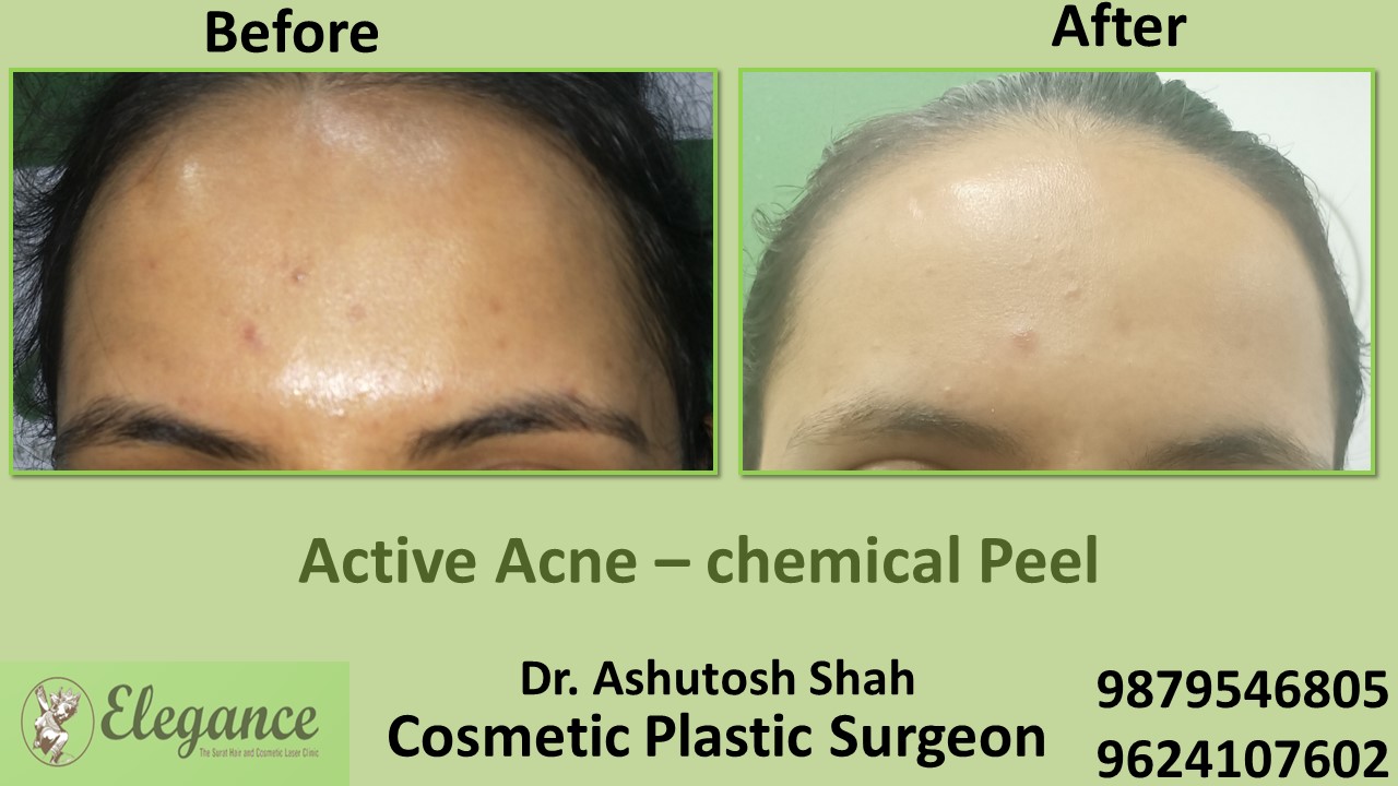 Acne Chemical Peel Treatment in Vapi, Surat