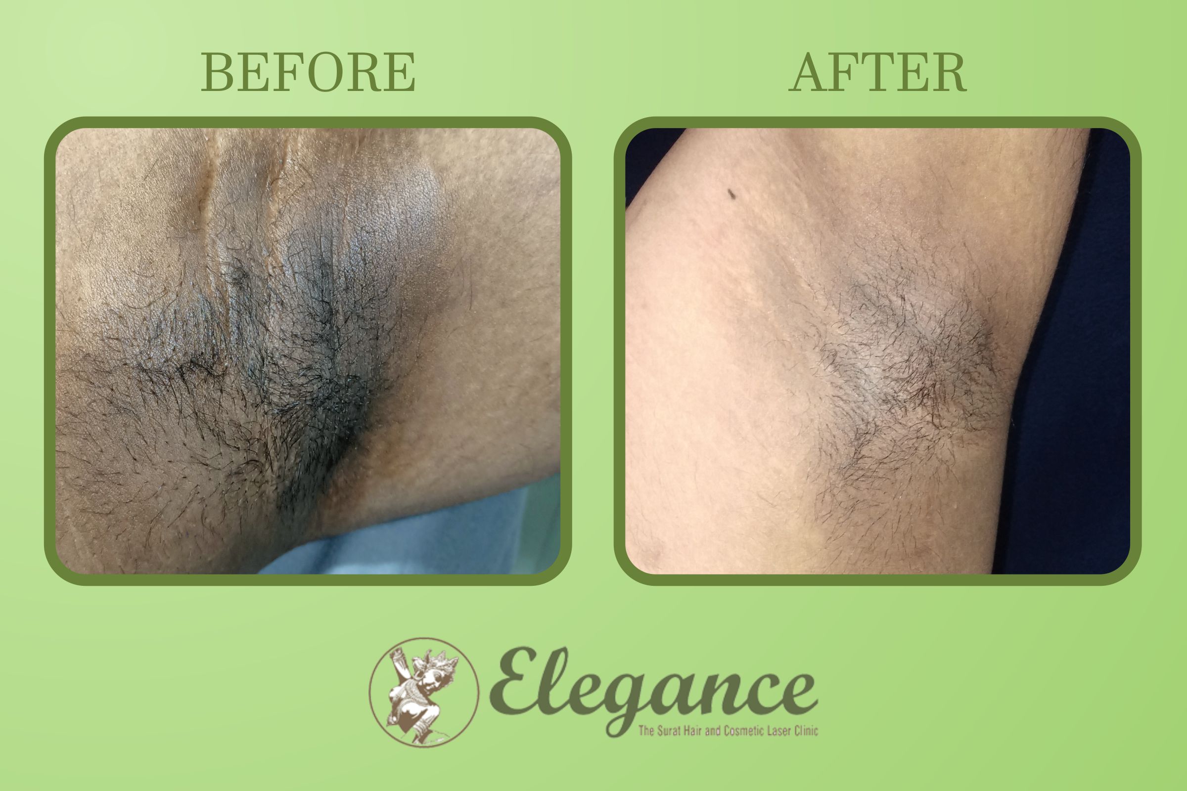 Axillary Chemical Peel Before After In Surat, Gujarat, India