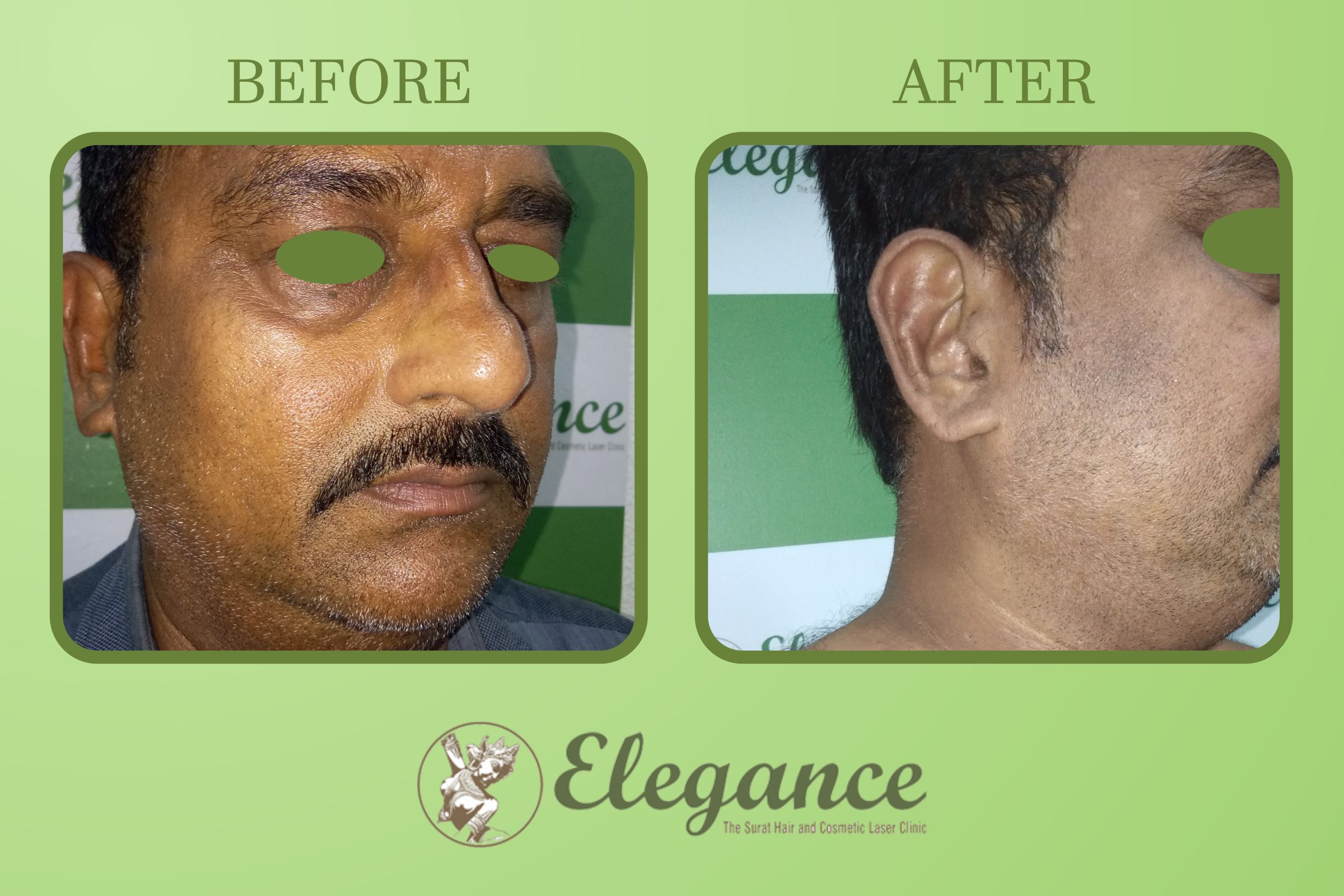 Before After Result Chemical Peel In Surat, Gujarat, India
