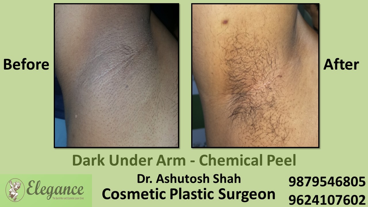 Chemical Peel in Skin in Navsari