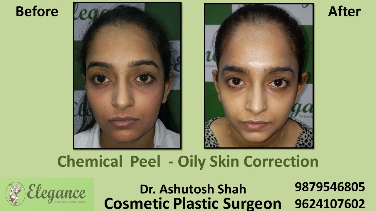 Chemical Peel in skin in Valsad, Surat