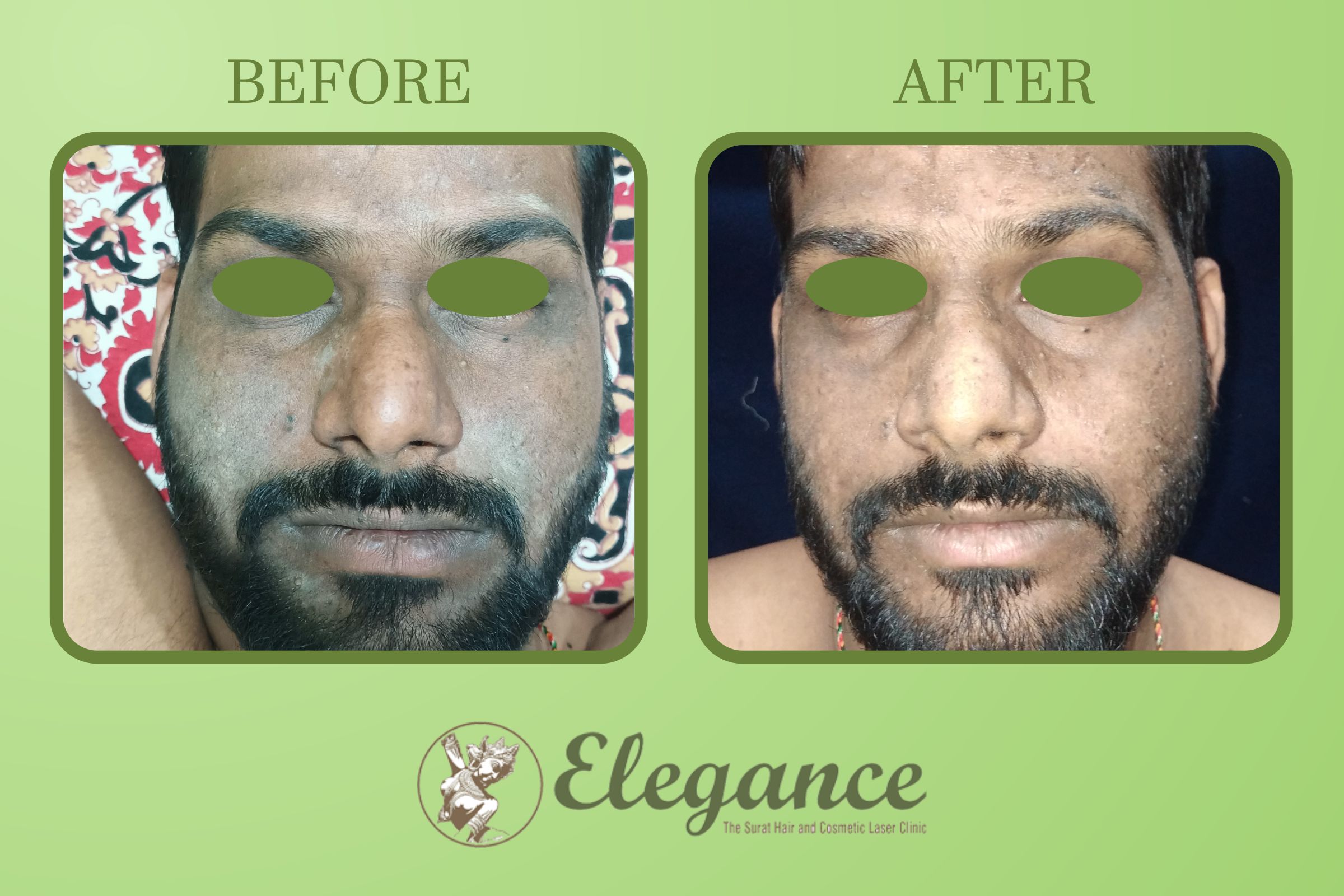 Chemical Peel On Acne Skin In Surat, Gujarat, India