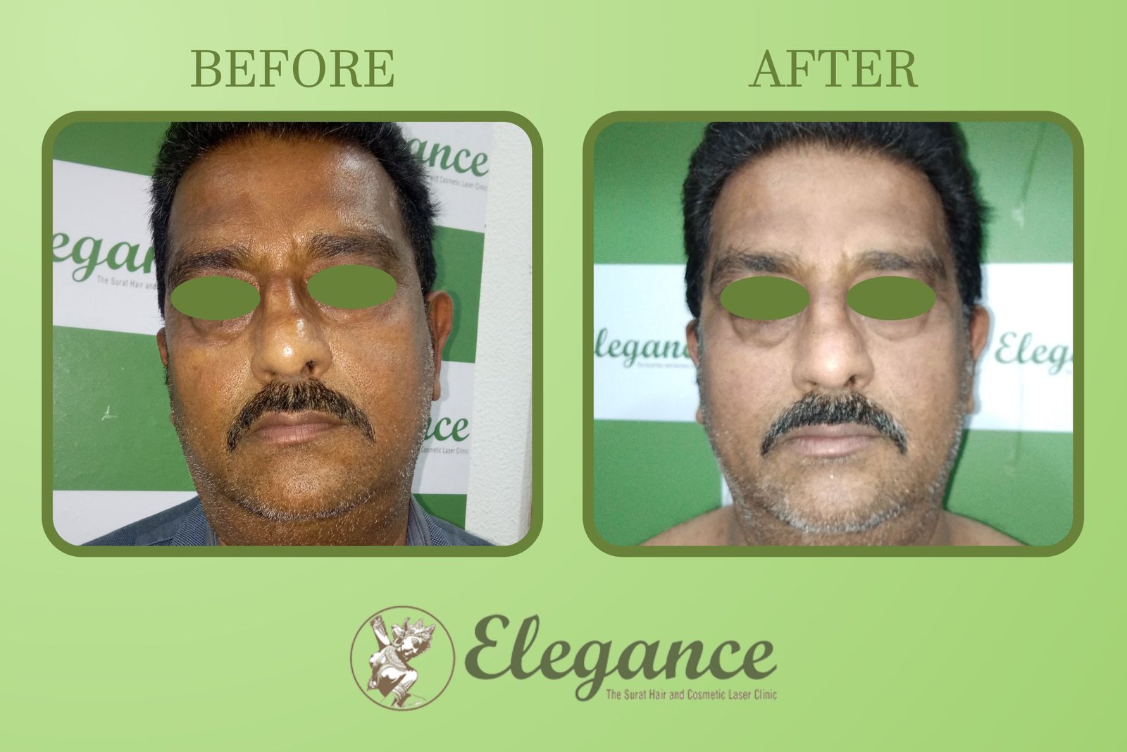 Chemical Peel On Fcae In Surat, Gujarat, India