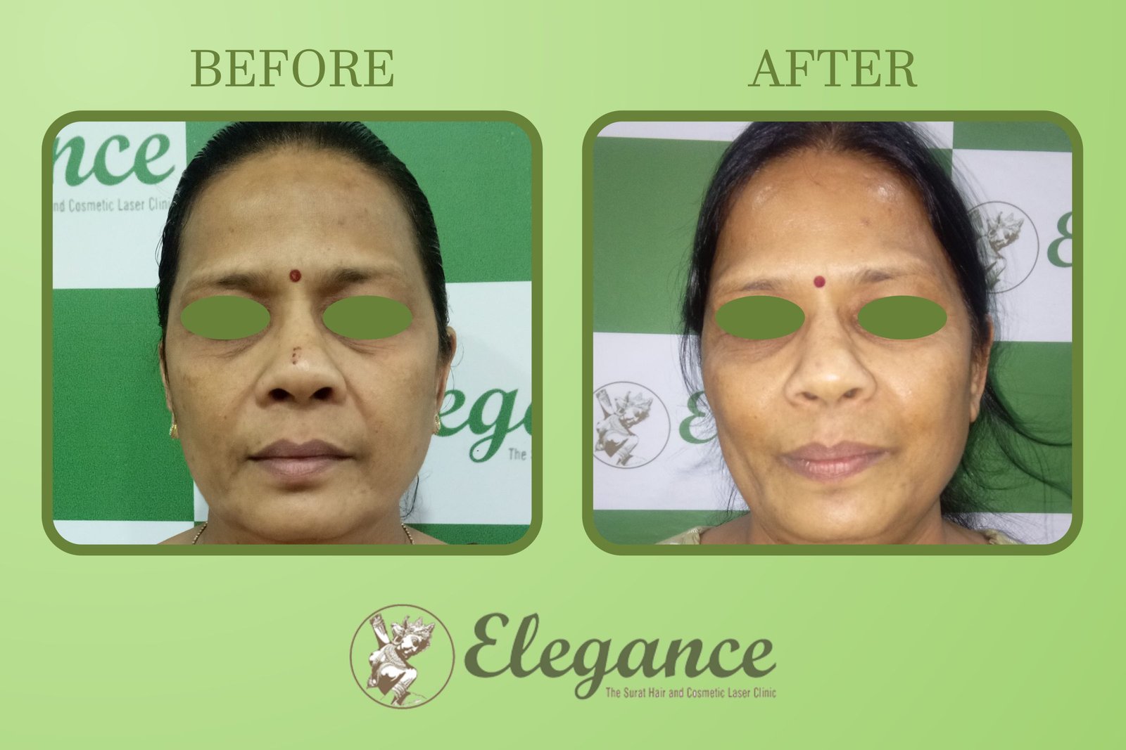 Chemical Peels Treatment in Surat, Gujarat (India)