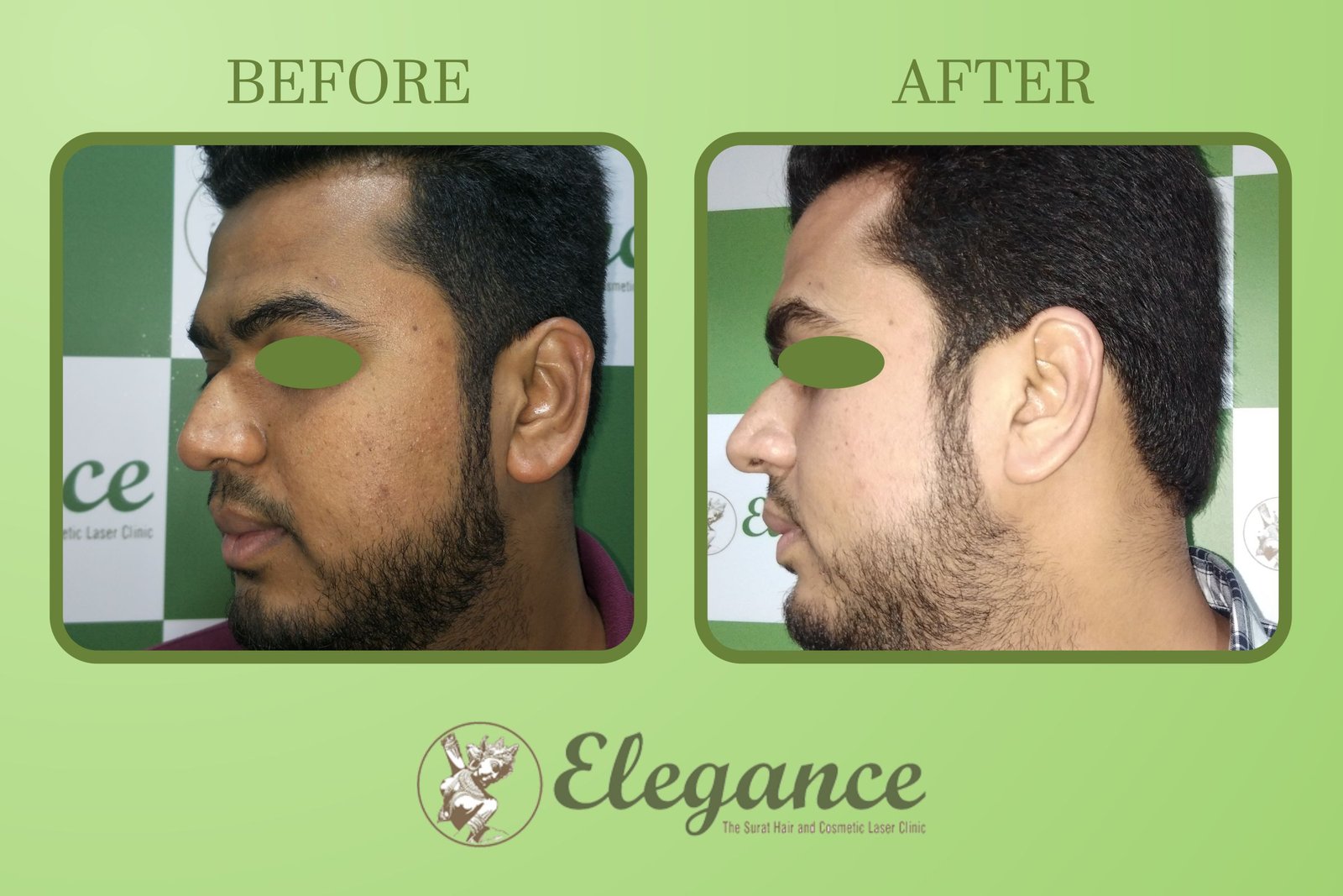 Chemical Skin Peel Result Surat, Gujarat, India