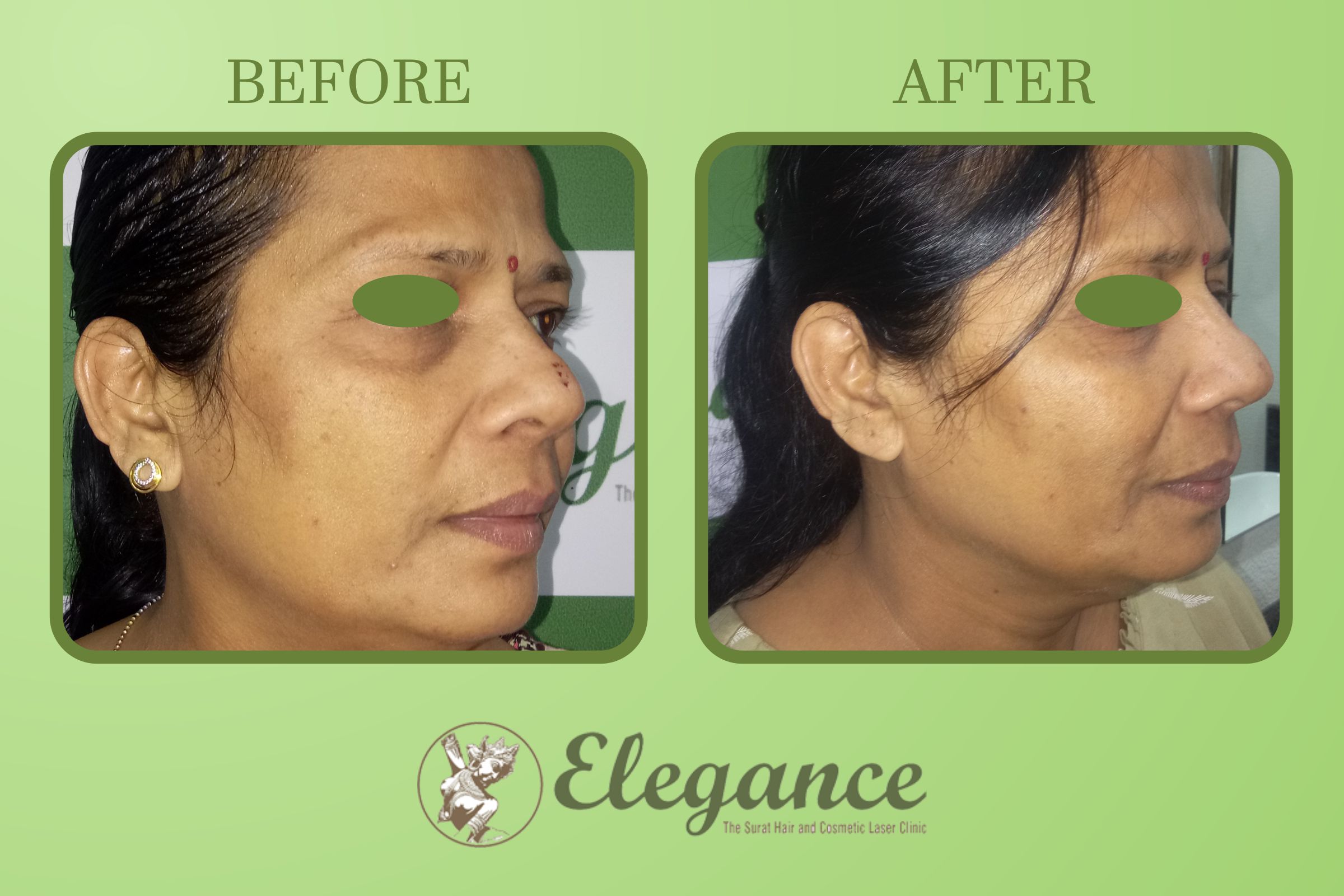 Chemical Treatment On Sensetive Skin Surat, Gujarat, India