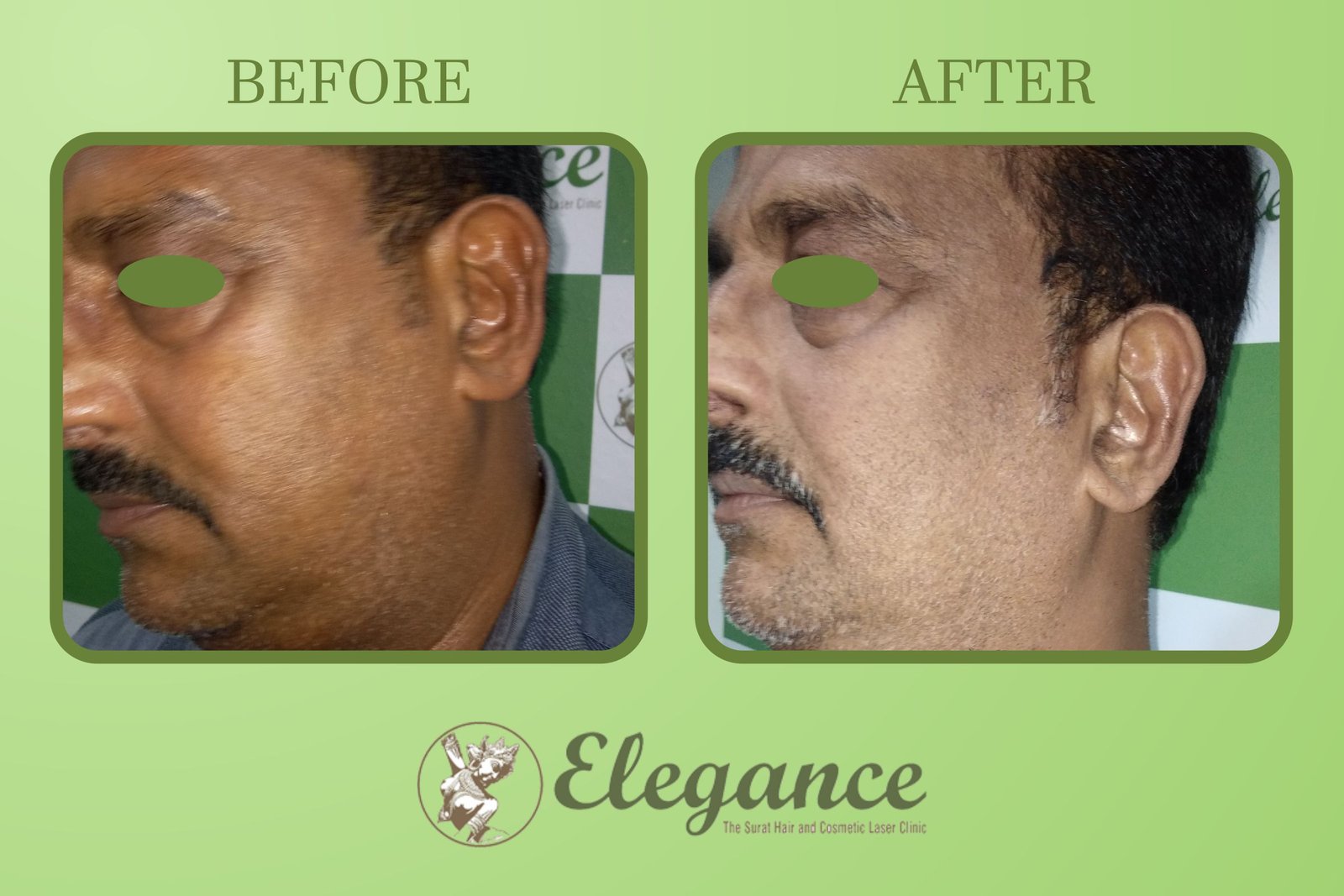 Face Chemical Peel Result In Surat, Gujarat, India