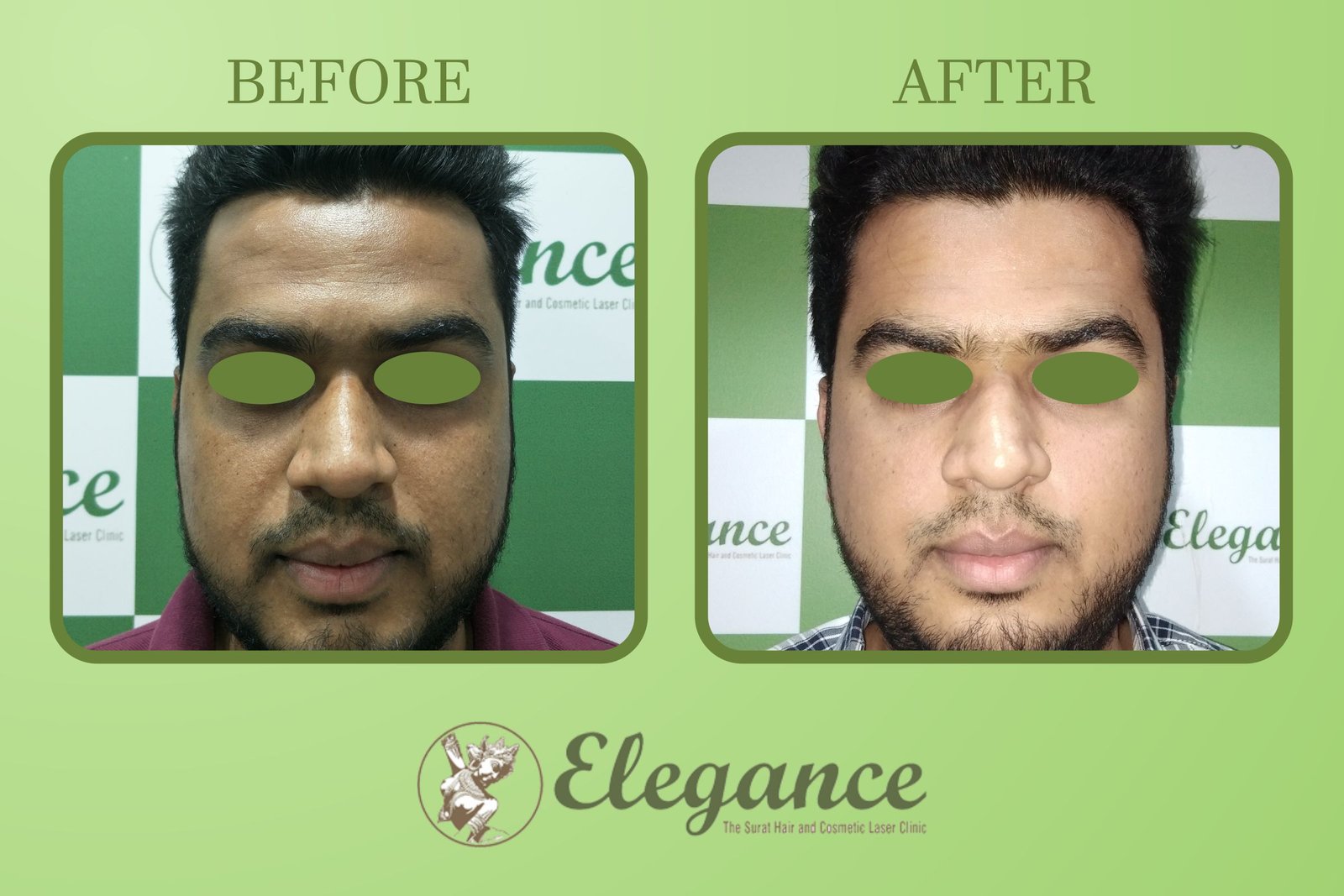 Face Transforming Chemical Peel In Surat, Gujarat, India