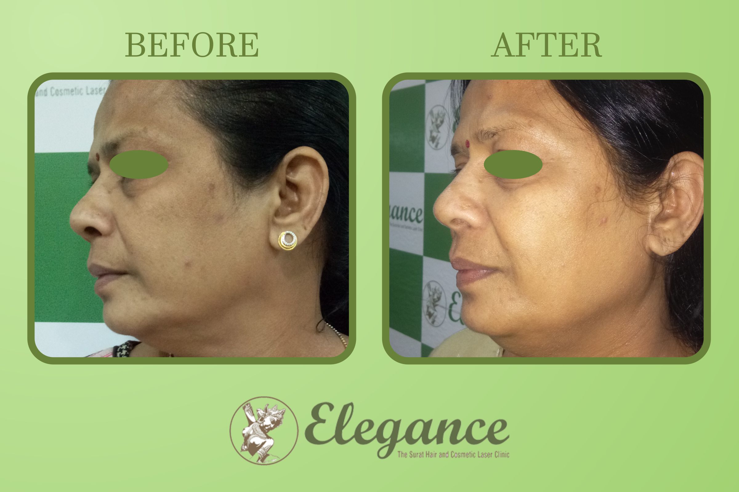Results For Chemical Peeling In Surat, Gujarat, India