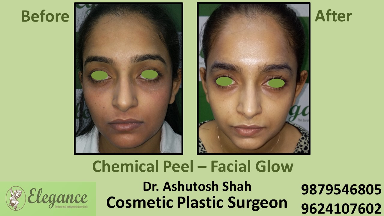 Chemical Peel Facial Glow Treatment in Vapi, Surat
