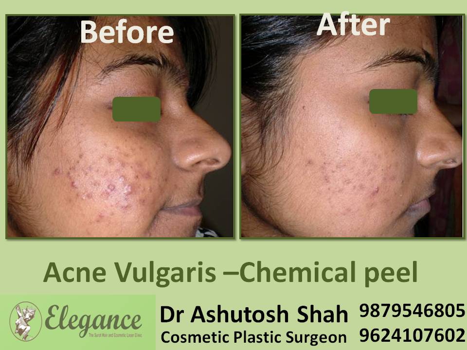 Chemical Peel Before And After In Surat, Gujarat, India