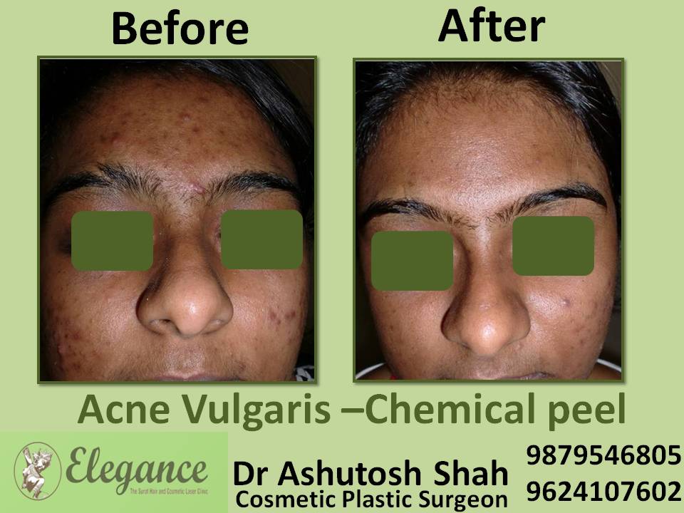 Acne and Pores treatment in Surat, Gujarat (India)