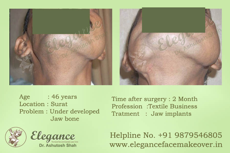 Face Makeover Before and After Surat, Gujarat, india