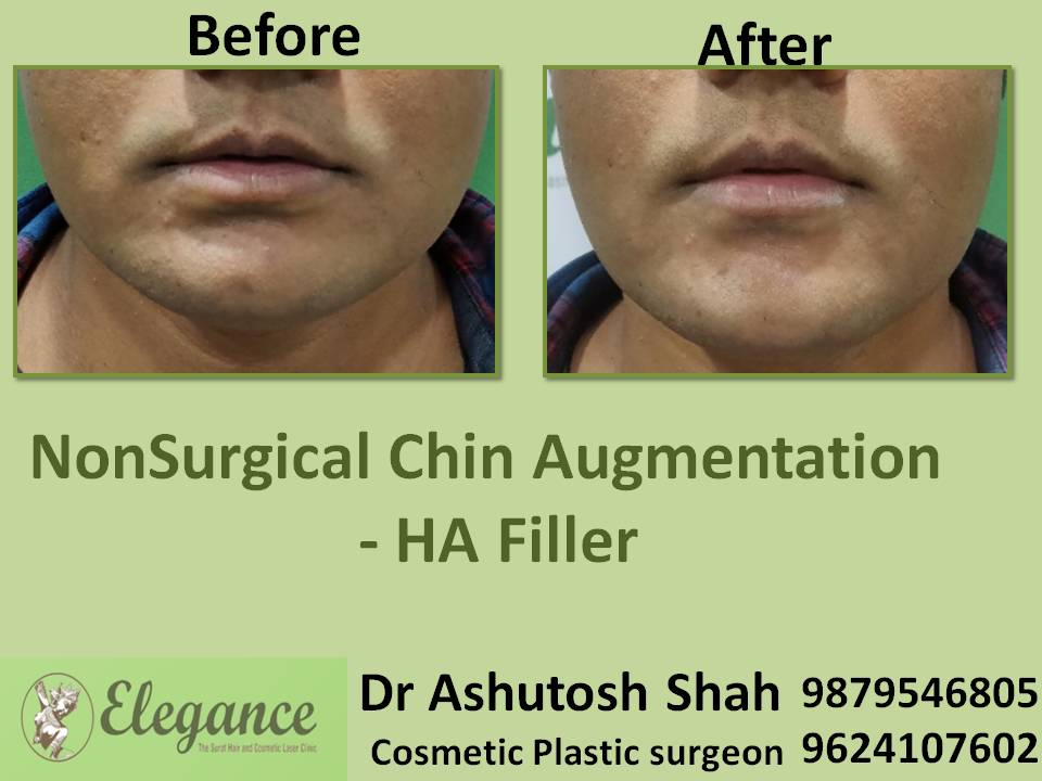 Nonsurgical Chin Augmentation Filler In Surat, Gujarat, India