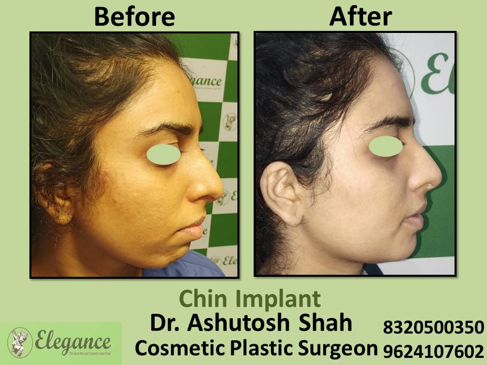 Face Makeover - Chin Implant, Augmentation, Vesu, Citylight, Piplod, Althan, Surat