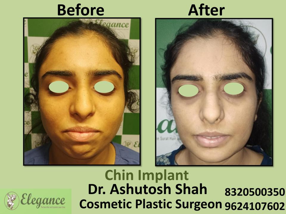 Chin Implant Surgery, Makeover, Nanpura, Sarthana, Palanpor, Gopipura, Surat