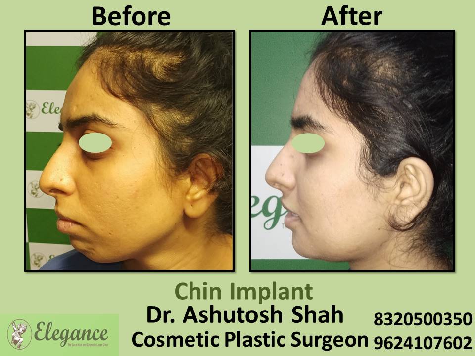 Chin Implant Surgery, Face Augmentation, Laldarwaja, Nanpura, Majura, Dindoli, Surat.