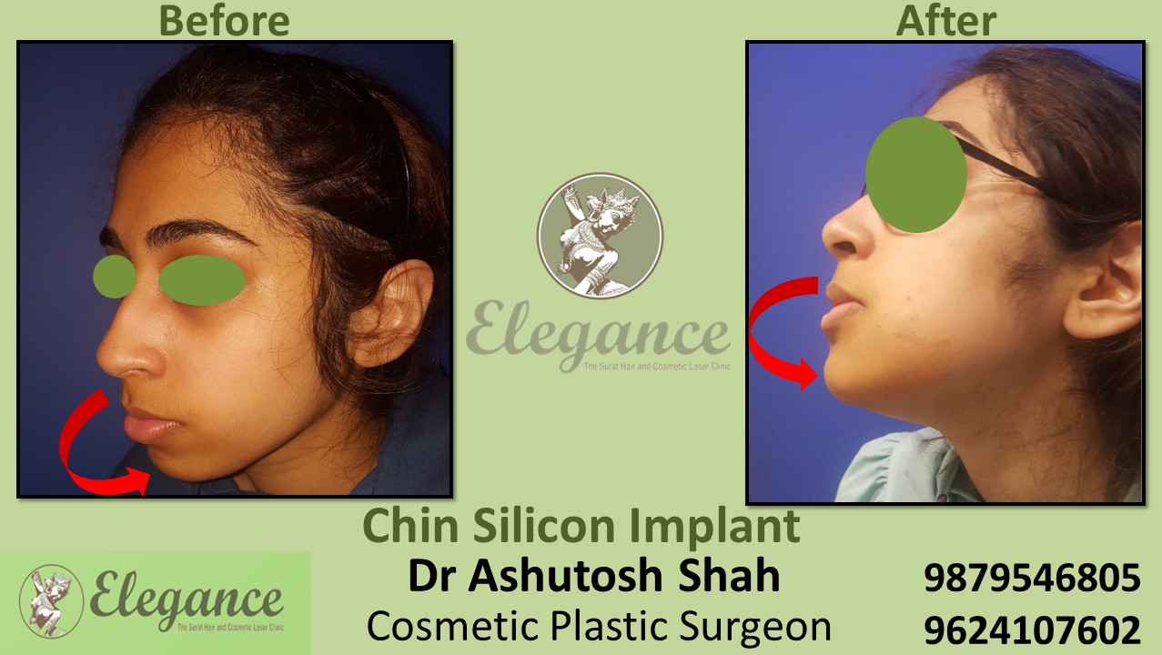 Chin Implant Treatment in Vesu, Adajan, Athwalines, Surat