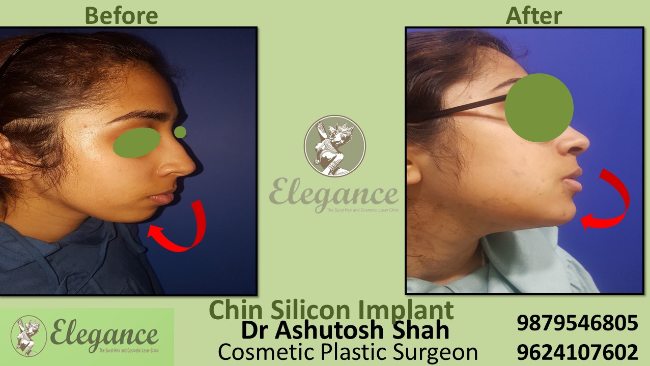 Chin Reshaping Surgery in Olpad, Katargam, Varachha, Surat