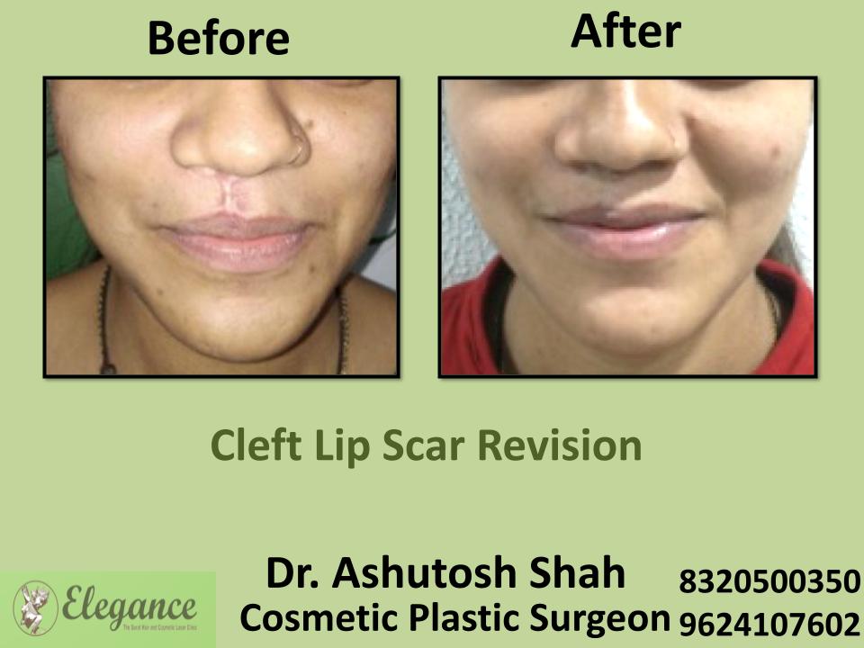 Cleft Lip Scar, Lip Scar Revision Before And After Surgery, Sarthana, Palanpor, Pal, Jahangirpura, Surat, Gujarat.