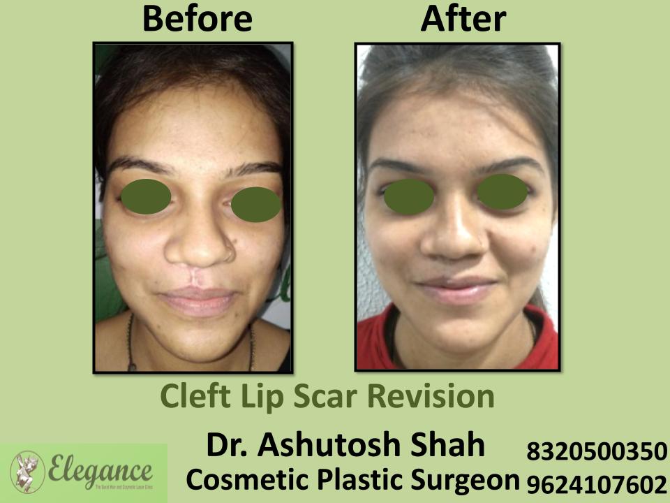 Cleft Lip Scar, Lip Scar Treatment, Best Surgeons, Udaipur, Kacch, Mundra, Bhacchau, India.