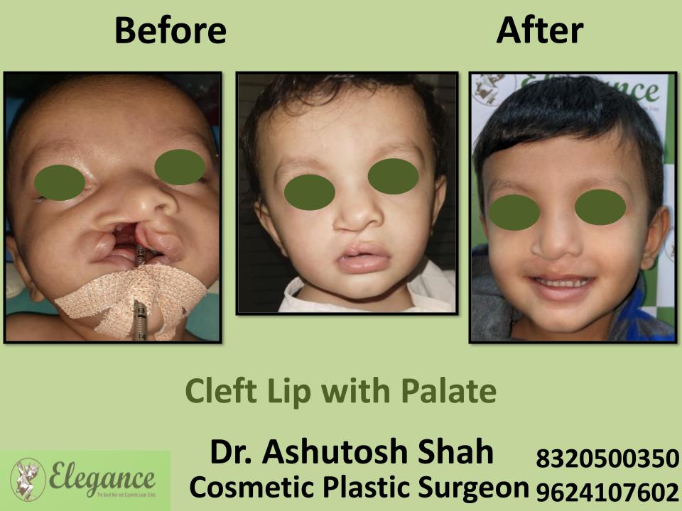 Cleft With Lip With Palate, Lip Repairing, Correction And Treatment Surgery, Nanpura, Gopipura, Athwa, Rander, Surat, Gujarat.