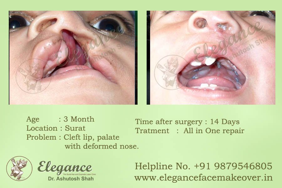 Face Makeover Results Surat, Gujarat, india