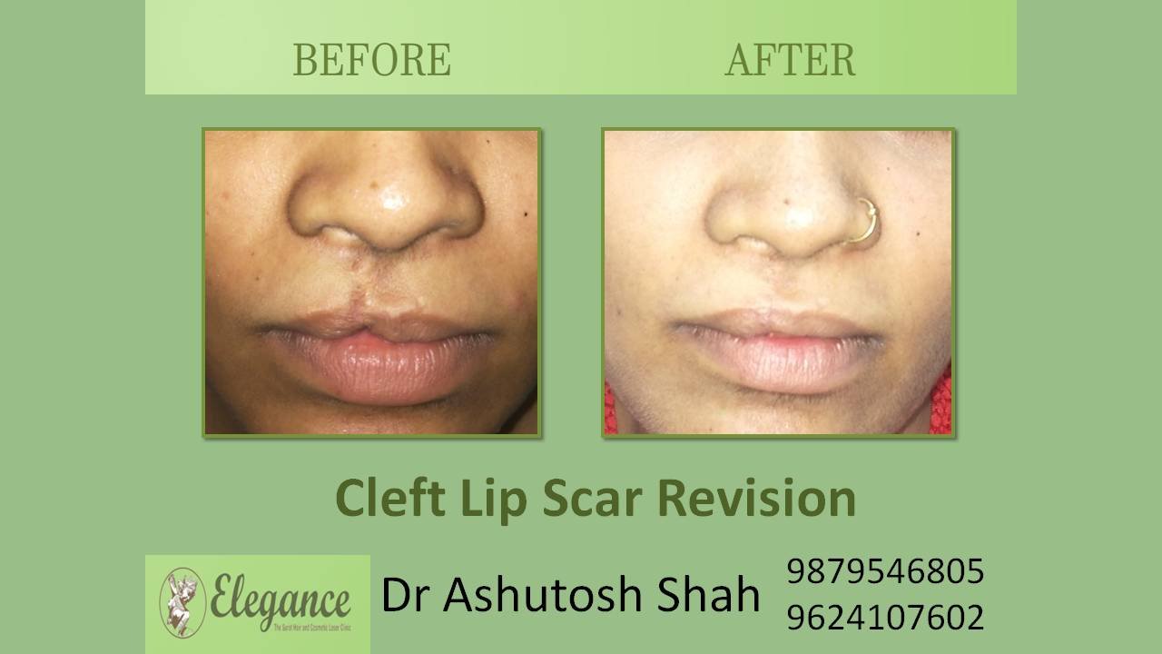 Scar Revision Cleft Lip In Surat, Gujarat, India